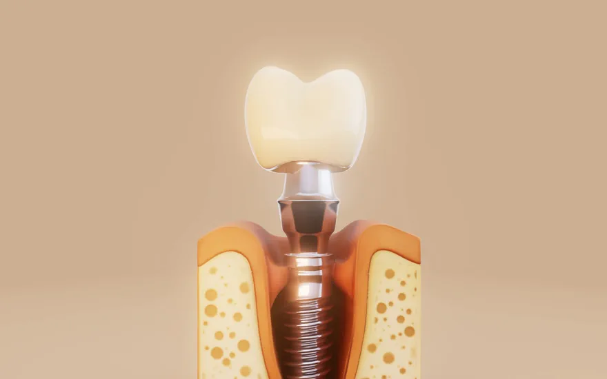 잇몸뼈 단면과 임플란트 식립 구조를 나타낸 3D 개념 이미지